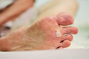 Symptoms and Causes of Plantar Warts