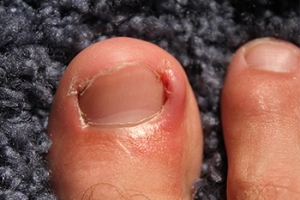 Proper Treatment for Ingrown Toenails